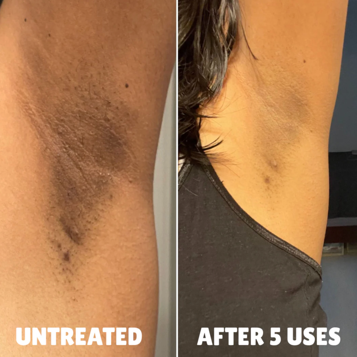 Advanced Triple Acid Complex For Hyperpigmentation