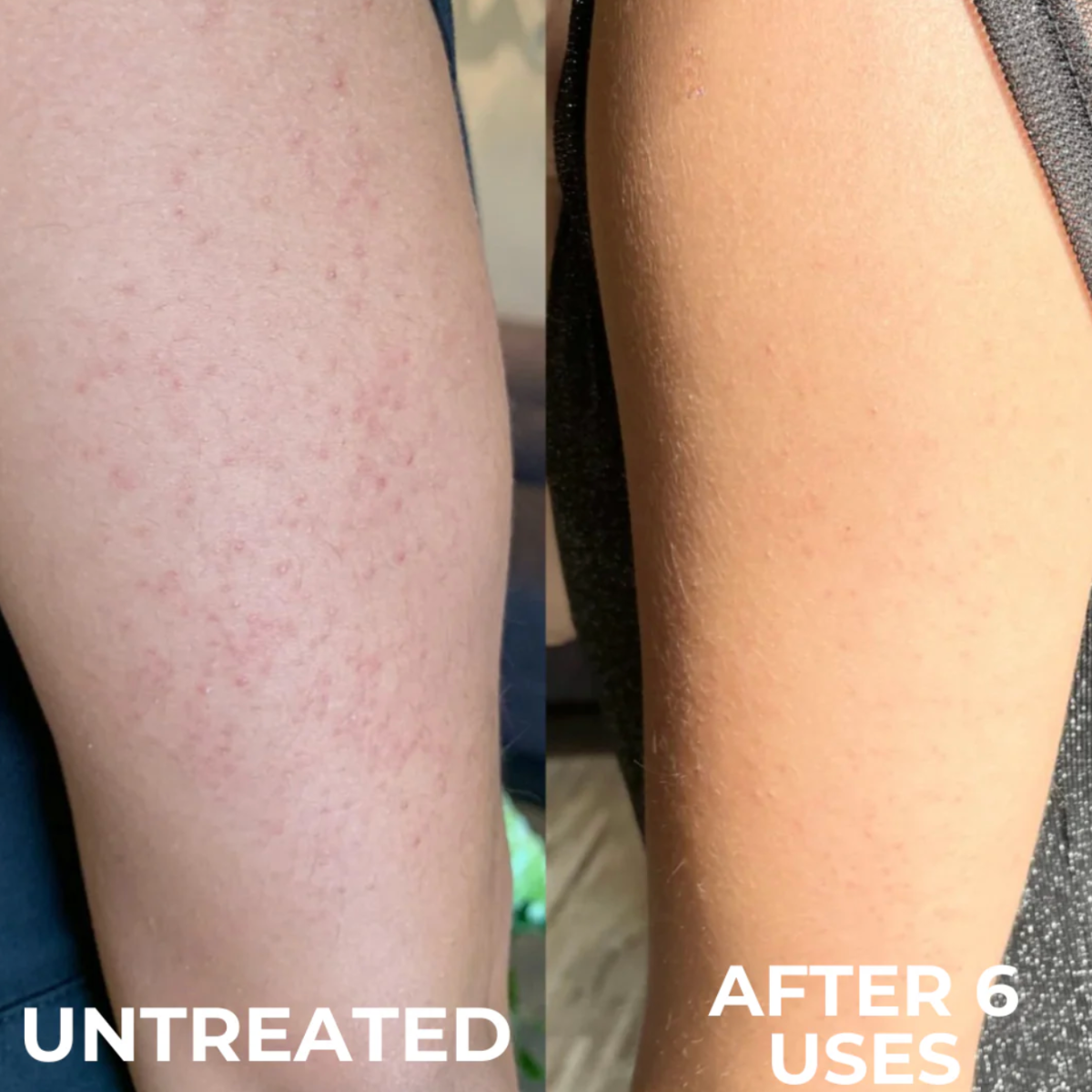 Advanced Triple-Acid Complex for Keratosis Pilaris