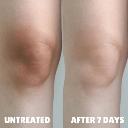 Advanced Triple Acid Complex For Hyperpigmentation
