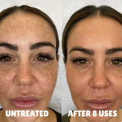 Advanced Triple Acid Complex For Hyperpigmentation