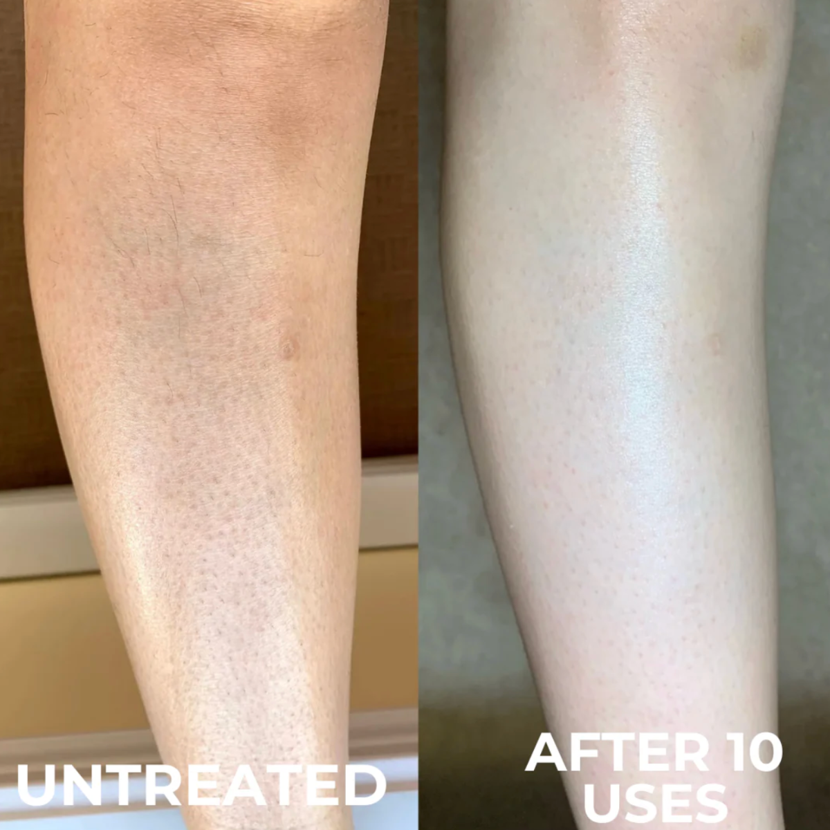 Advanced Triple-Acid Complex for Keratosis Pilaris
