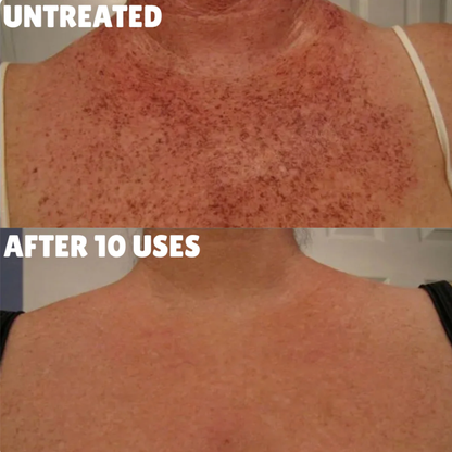 Advanced Triple Acid Complex For Hyperpigmentation